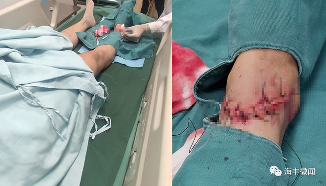 云南玉昆球员张祥硕被撞后出现眩晕伤势无大碍的简单介绍  第1张